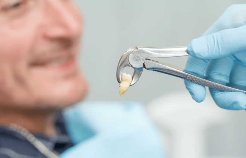 tooth extraction healing stage