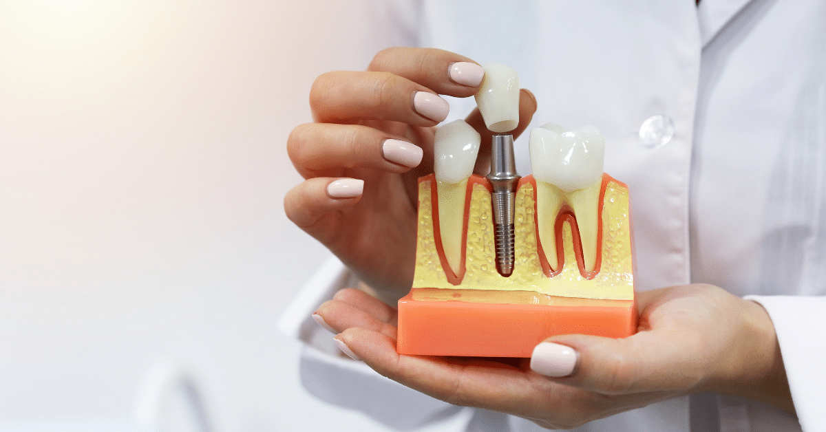 Dental Implants in Palatine