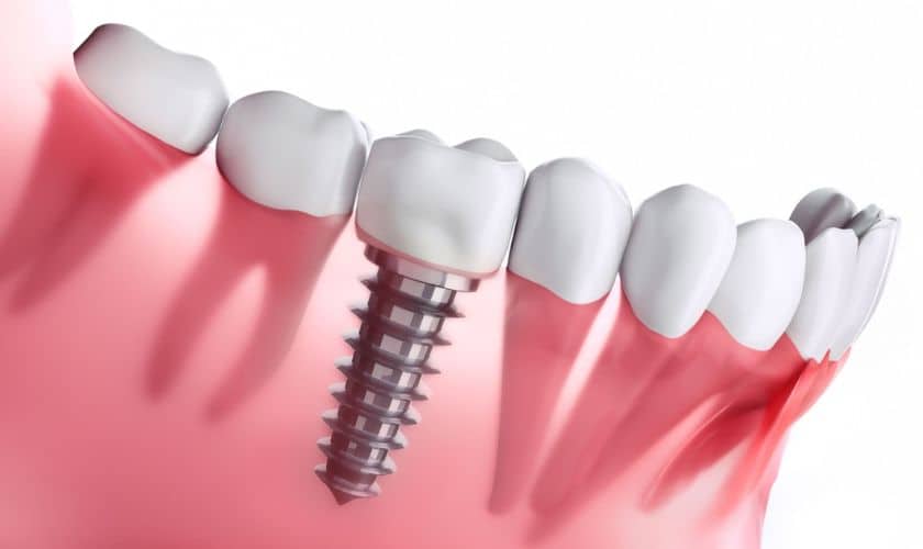 Dental Implants in Palatine- Palatine Dental Associates