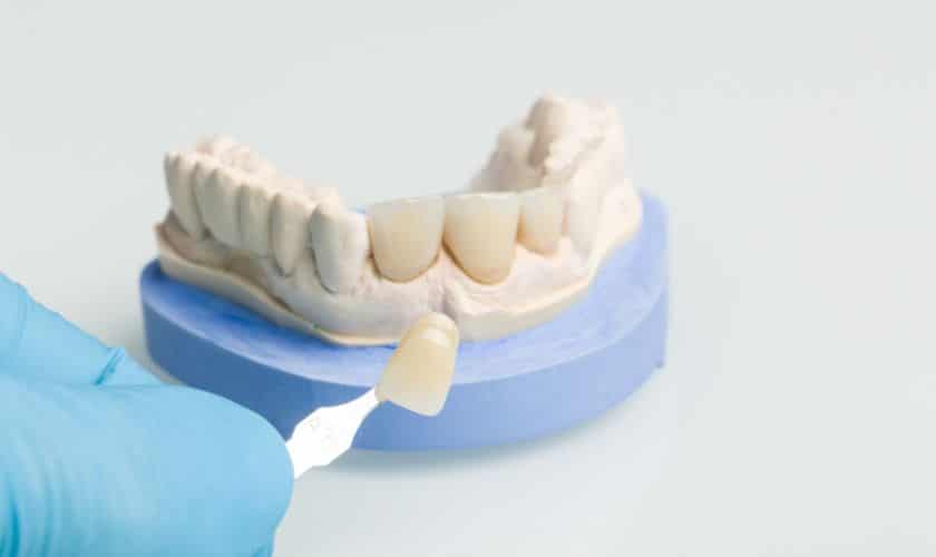 Dental Crowns in Palatine- Palatine Dental Associates