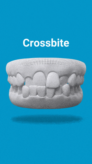 3D dental model displaying crossbite malocclusion on blue background for Palatine Dental Associates educational content.