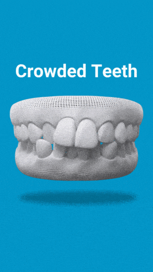 3D dental model showing crowded teeth on blue background with "Crowded Teeth" label