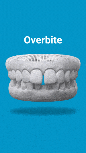 Dental model showing overbite condition with upper teeth overlapping lower teeth against blue background.