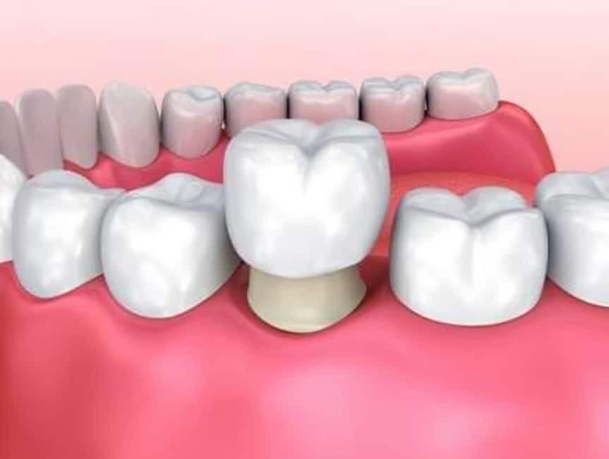 Dental crown placement illustration showing tooth restoration between adjacent teeth on pink gum background.