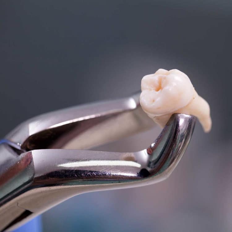 Dental forceps holding extracted tooth against blurred background during oral surgery procedure