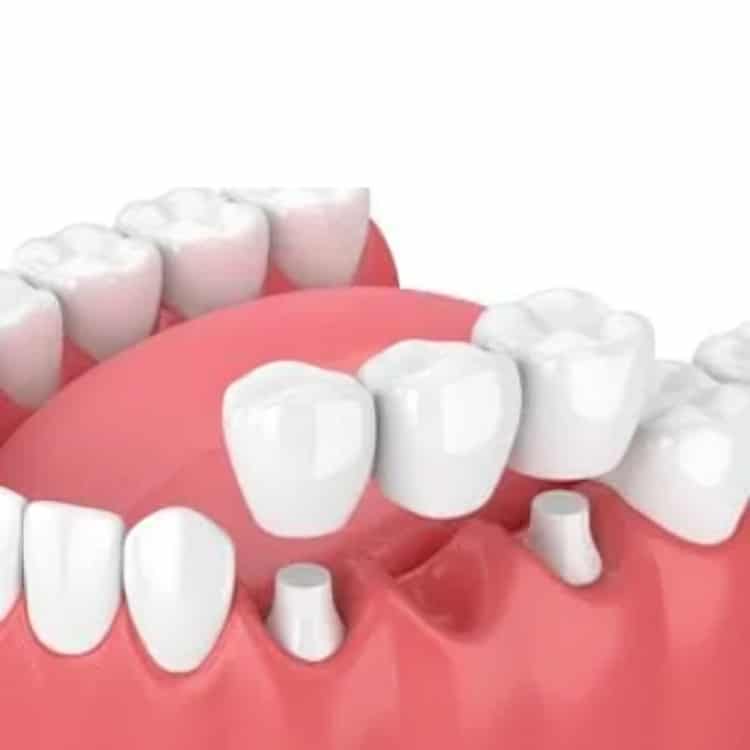 3D dental implant illustration showing tooth replacement in gum tissue with crown restoration.