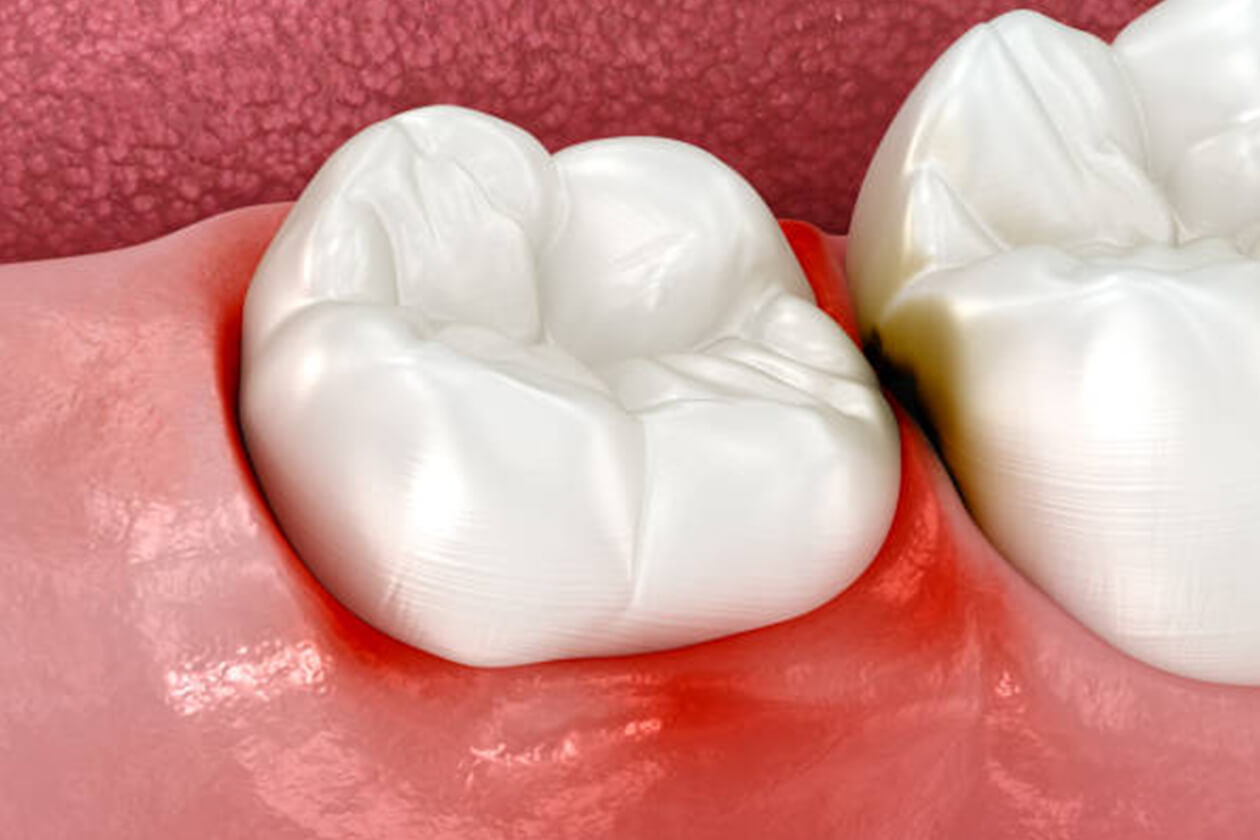 Dental crown model on inflamed gum tissue showing tooth restoration procedure.