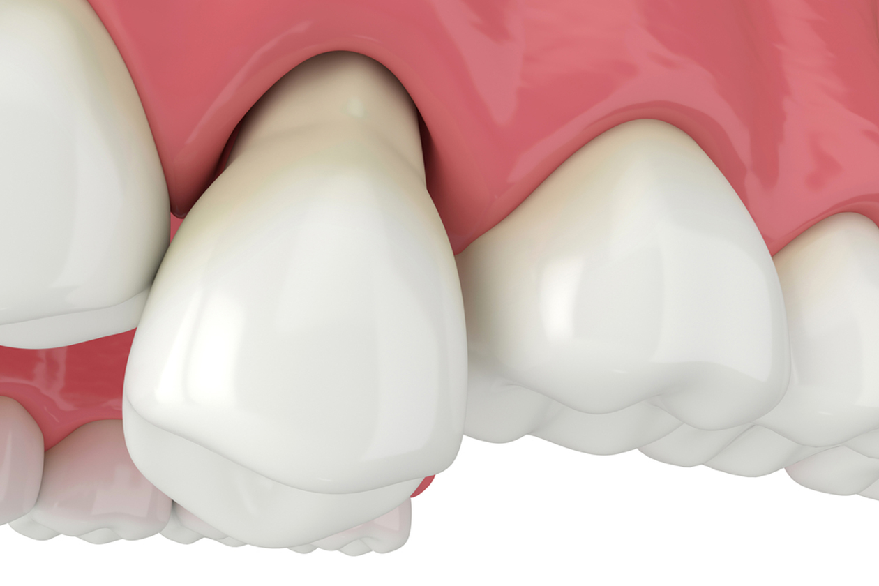 White dental crowns on pink gum model showing tooth restoration procedure.