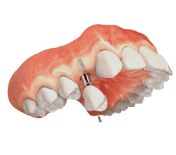 Dental implant diagram showing tooth replacement procedure in jawbone cross-section