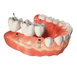 Dental implant model showing tooth replacement options on artificial gums and jawbone structure.