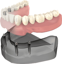 Dental implant model showing prosthetic teeth attachment to jawbone structure for implant dentistry demonstration.